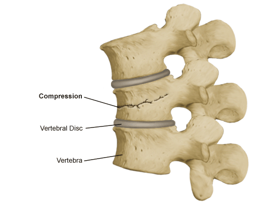 Best Treatments For Vertebral Compression Fractures